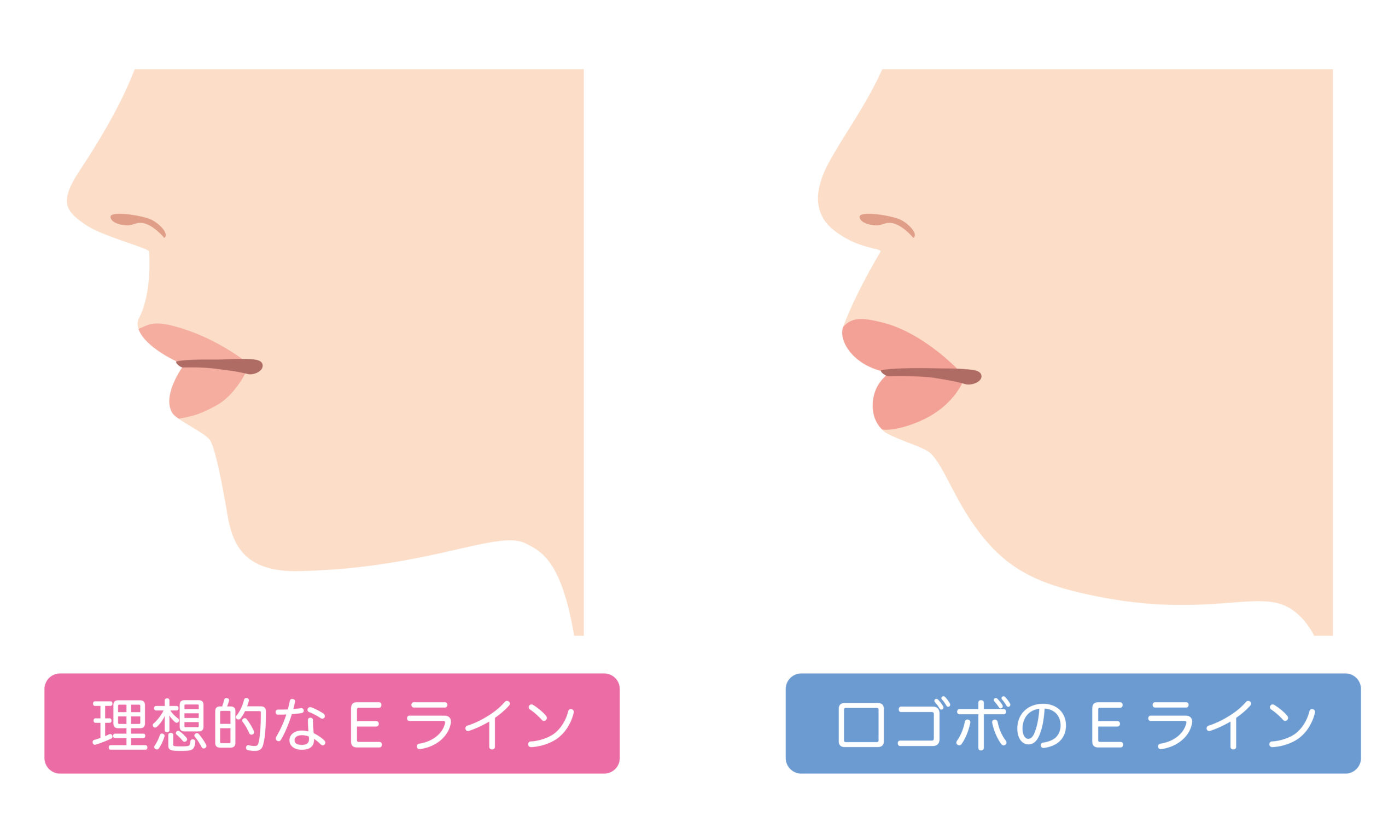 口ゴボ Eライン