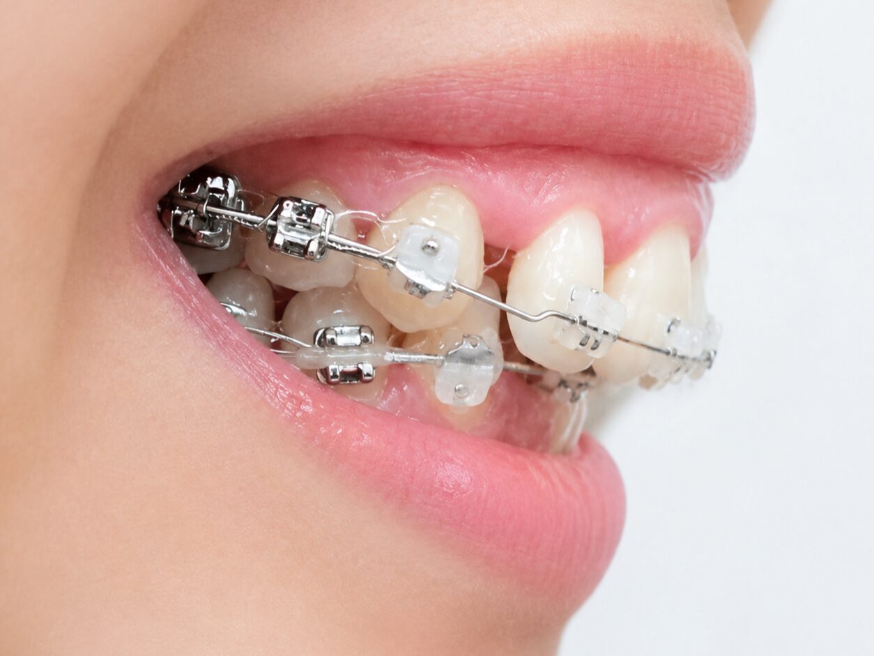 口ゴボは矯正歯科治療で改善できる?
